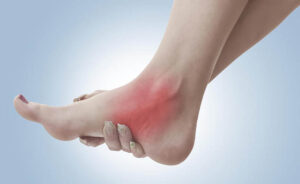 Bệnh gút (gout): Nguyên nhân, triệu chứng & cách điều trị bệnh tại nhà