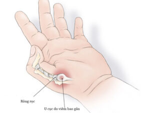 Đau khớp ngón tay: nguyên nhân, biến chứng & điều trị bệnh đau khớp