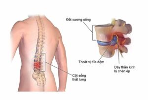 Hội chứng thắt lưng hông là gì: Nguyên nhân, triệu chứng và cách chẩn đoán