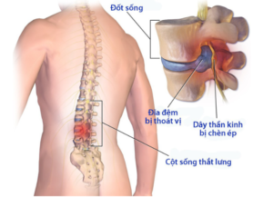 Thoát vị đĩa đệm thắt lưng: Nguyên nhân và Phương pháp hỗ trợ điều trị tại nhà